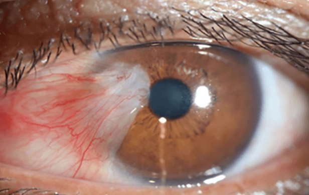 Pterygium Surgery in Pune