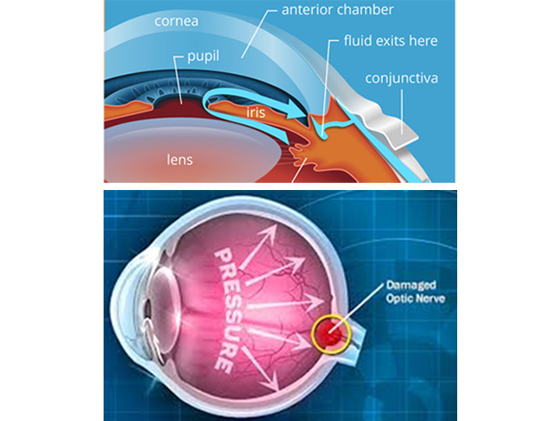 Glaucoma Eye Surgery in Pune