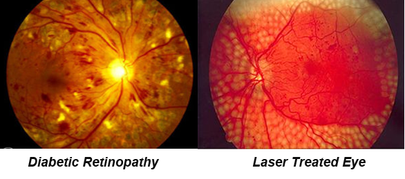 cataract eye surgery in viman nagar