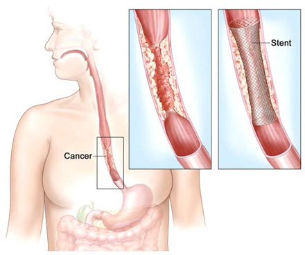 Esophageal Cancer Surgery Hospital in Pune