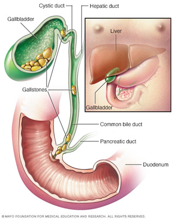 Gall Bladder Stones Surgery in Pune