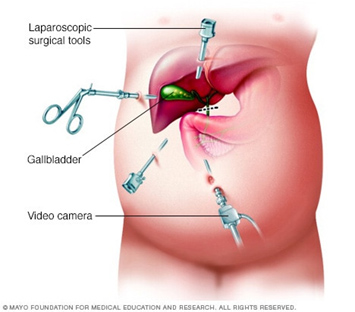 Gall Bladder Stones Surgery Hospital in Pune