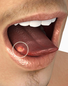 Tongue Cancer Surgery Hospital in Pune