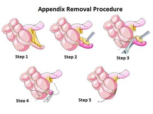 Appendix Surgery Hospital in Pune