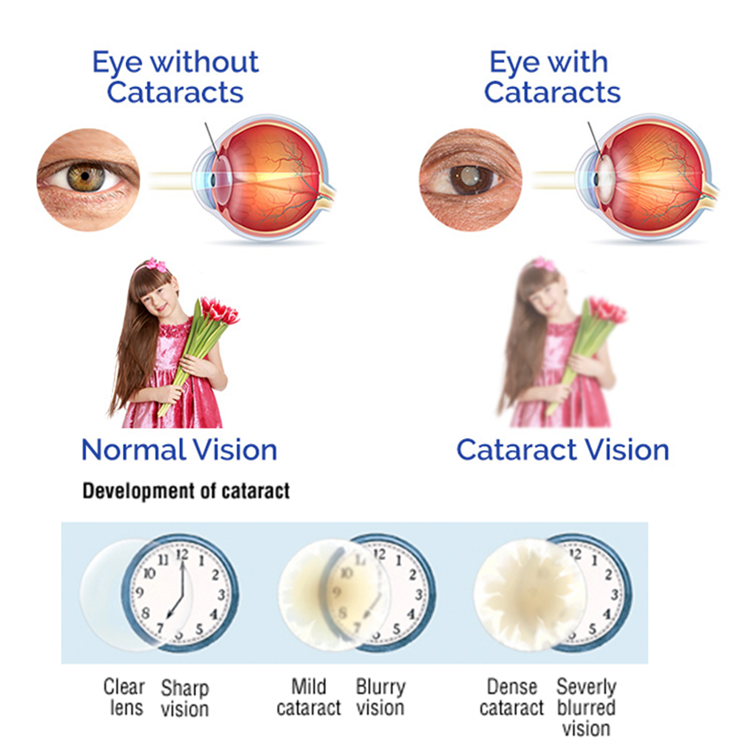 Cataract Eye Surgery in Pune