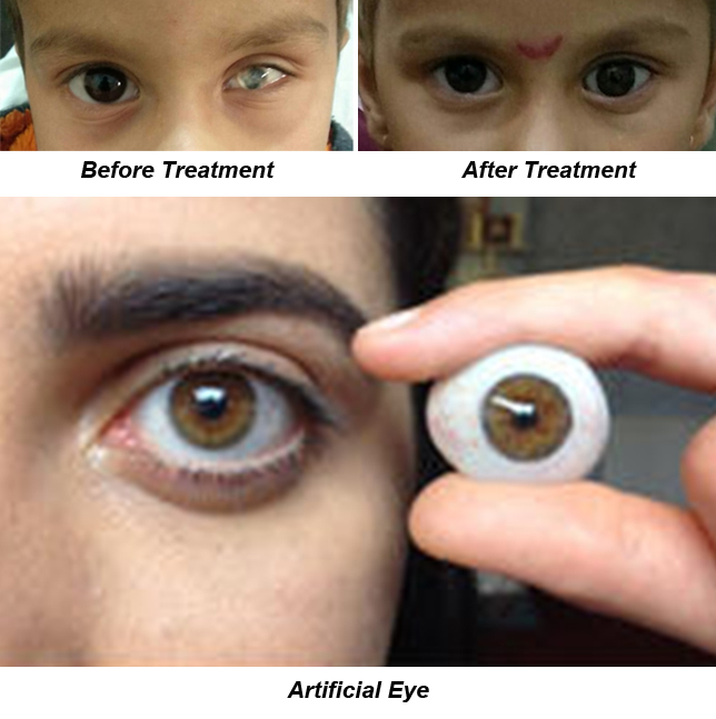Oculoplasty Eye Surgery in Pune