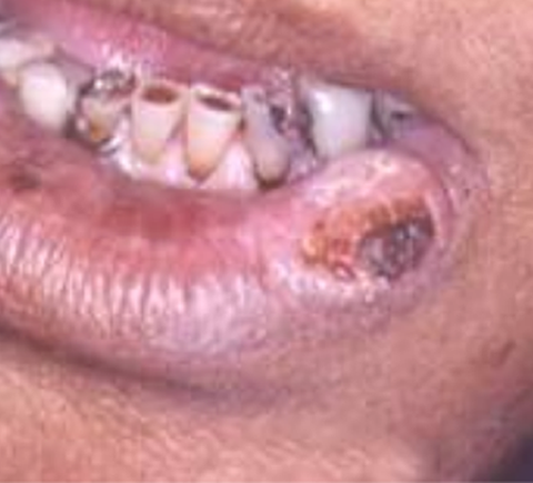 lip cancer from chewing