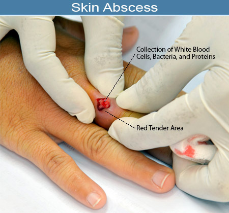 Abscess Surgery in Pune