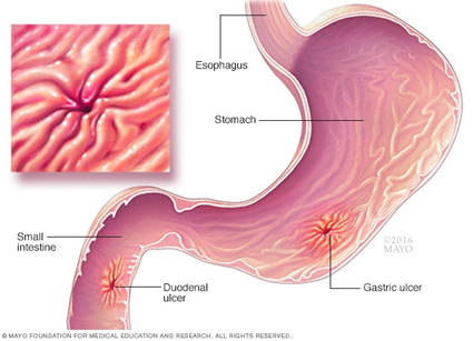 Gastric Ulcer Surgery in Pune